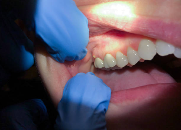Best Knocked-Out Tooth (Avulsed Tooth) Treatment in West Yellowstone, MT